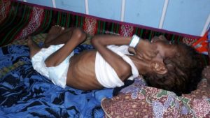 DPRD Kaimana Temukan Balita Diduga Penderita Gizi Buruk